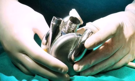 Histórico avance médico: un hombre vivió con un corazón artificial por 100 días hasta recibir un trasplante