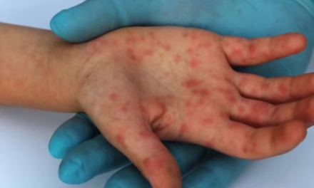 México acumula 7 mil 600 casos de sarampión