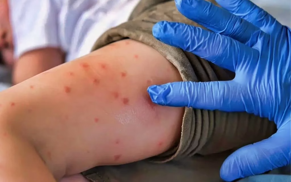 Por que los adultos mayores NO deben vacunarse contra el sarampión? Esto dice la UNAM