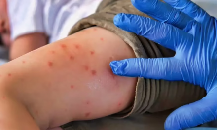 Por que los adultos mayores NO deben vacunarse contra el sarampión? Esto dice la UNAM