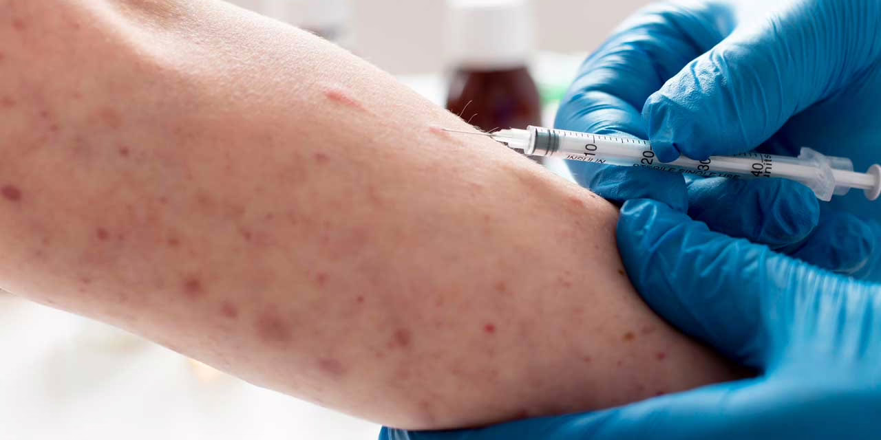 Síntomas, vacunas, prevención, todo lo que necesitas saber sobre como tratar el Sarampión