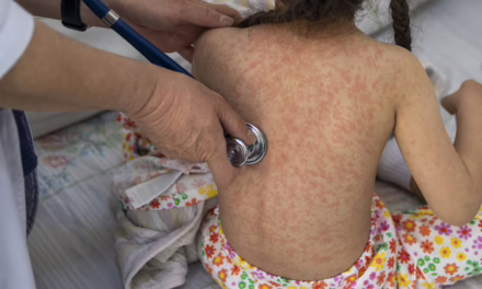 Secretaría de Salud reporta la sexta muerte por sarampión durante este 2026